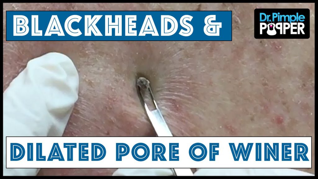 Video: Blackheads & a Dilated Pore of Winer, courtesy of Dr Pimple Popp...