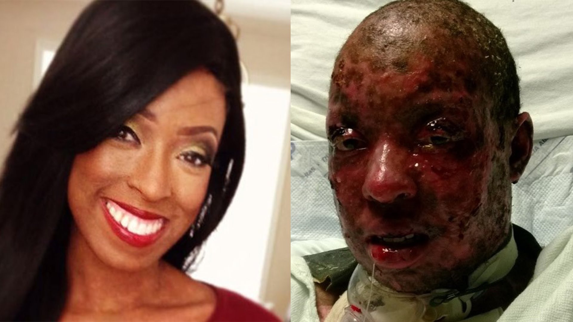 Video: Shocking allergic reaction: Girl's skin peels off; Makeup fail ... Makeup Allergic Reaction