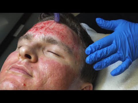 Video: Results of My 2nd DermaPen Acne Scar Treatment | SIDE BY SIDE COMPARISON