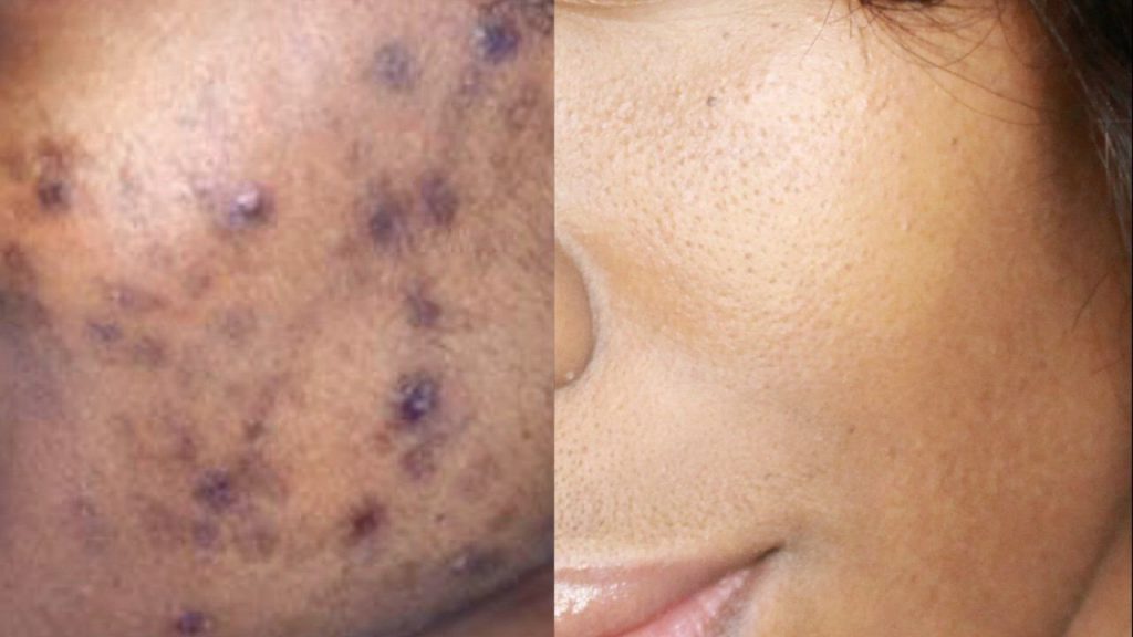 HOW TO GET RID OF ACNE SCARS HYPERPIGMENTATION