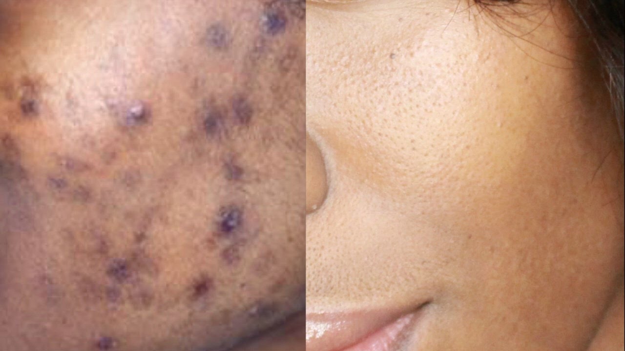 Video: HOW TO GET RID OF DARK SPOTS, ACNE SCARS ...