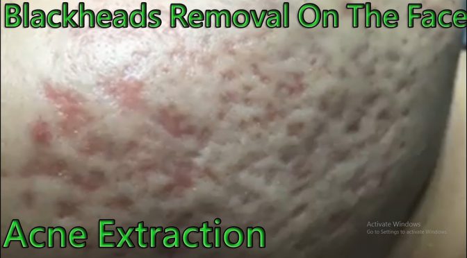 Video: Blackheads Removal – Full Acne Extraction On The Face #5