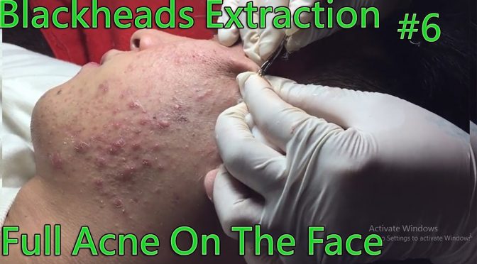 Video: Blackheads Removal – Full Acne On The Face Extraction #6