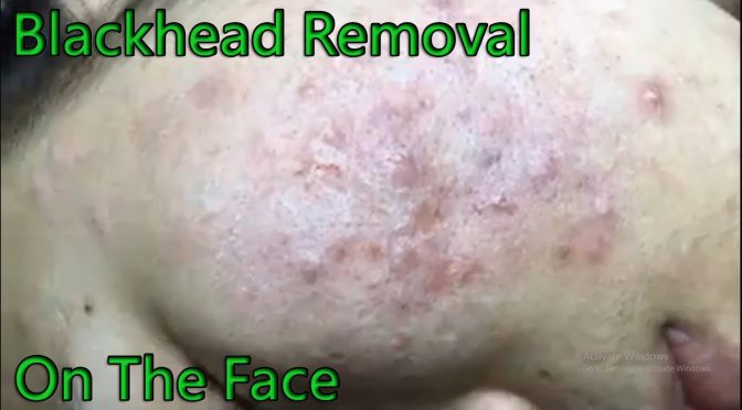 Video: Severe Cystic & Blackhead Removal – Acne Treatment #2