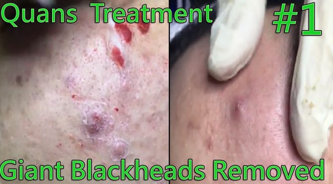 Video: Blackheads Removal – Full acne Extraction On The Face – Quan’s Treatment