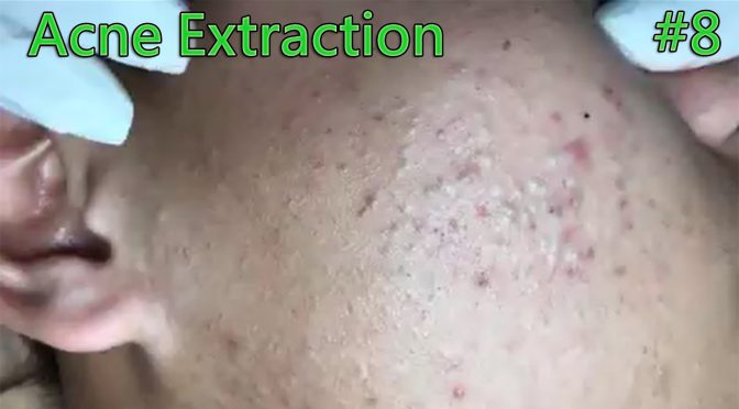 Video: Blackheads Removal – Full Acne Extraction On The Face #8
