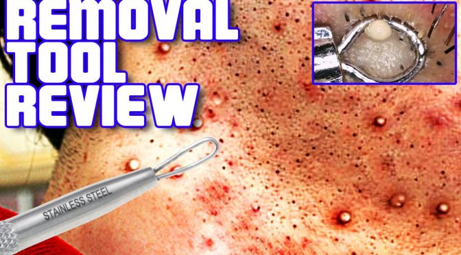 Video: Blackhead Remover Pimple Comedone Extractor Tool! Best Acne Removal Kit – Treatment for Blemish,