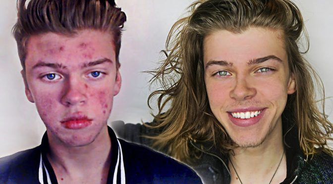 Video: MY ACNE STORY – BEFORE & AFTER!
