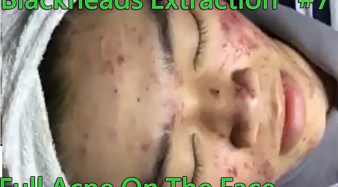 Video: Blackheads Removal – Full Acne On The Face Extraction #7